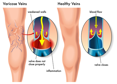 Varicose Veins: How To Avoid Them And 7 Ways To Treat Them - Botox Training  & Education