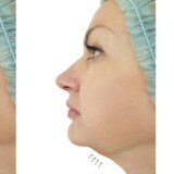 How To Help Balance A Face With Chin Fillers