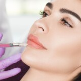 Juvéderm Can Restore Aging Lips In Minutes