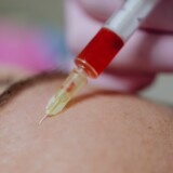 Can At-Home Conotoxin Products Replace Botox Injections?