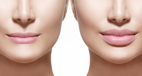 Fillers are chemicals that are injected into the face to fill in creases and lines and add volume to places like the lips or cheeks.