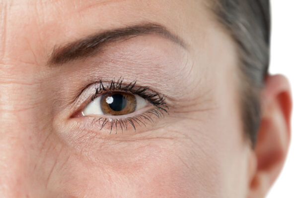 "Crow's feet," the wrinkles and lines that form around the eyes, are a major aesthetic issue for many people.