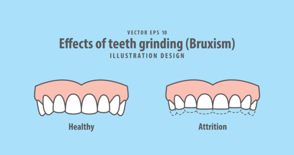The parafunctional activity of clenching or grinding teeth, known as bruxism, can occur at any time of the day or night.