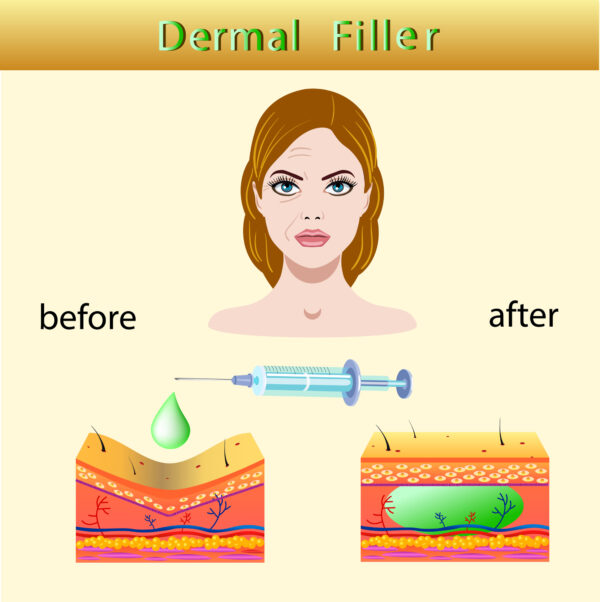 When dermal fillers are used in conjunction with Botox, the results can endure for up to a year.