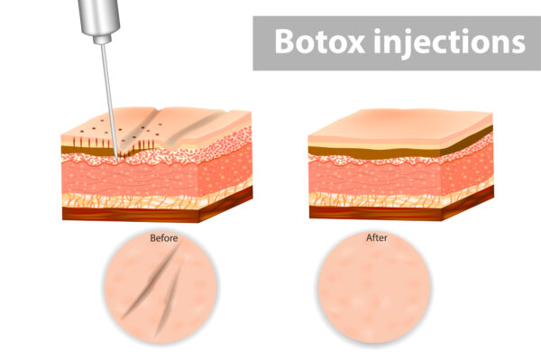 Botox injections reduce fine lines and wrinkles for a smoother, younger complexion.