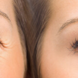A Brief Introduction to the Botox® Treatment for the Areas Beneath the Eyes