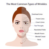 How Successful Are Injectables for Wrinkle Treatment?