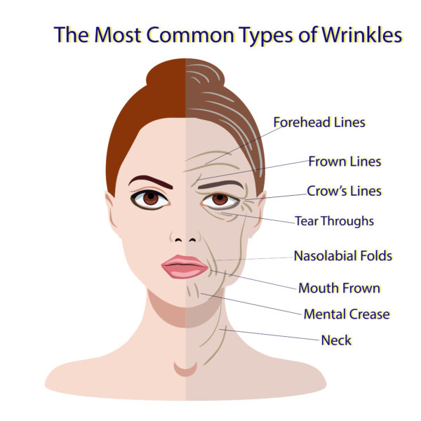 Both men and women can use Botox to lessen the prominence of nasolabial folds (smile lines) and smoker's lines (vertical wrinkles around the lips).