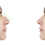 A Guide for Patients Receiving Nose-Tip Botox®