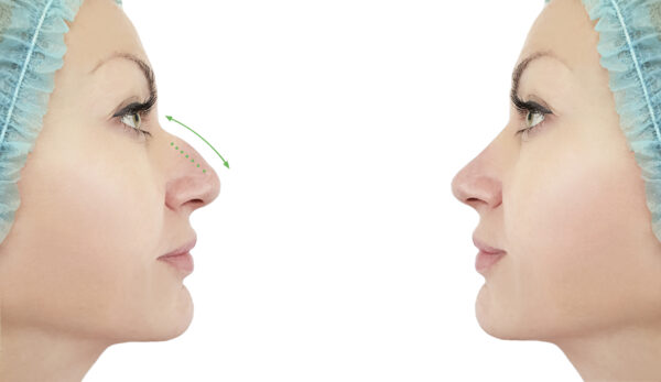 Drooping of the tip of the nose is a frequent cosmetic concern among people of all ages that can be temporarily addressed with Botox.