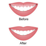 Improving Your Smile Makeover Outcomes With Botox® Injections