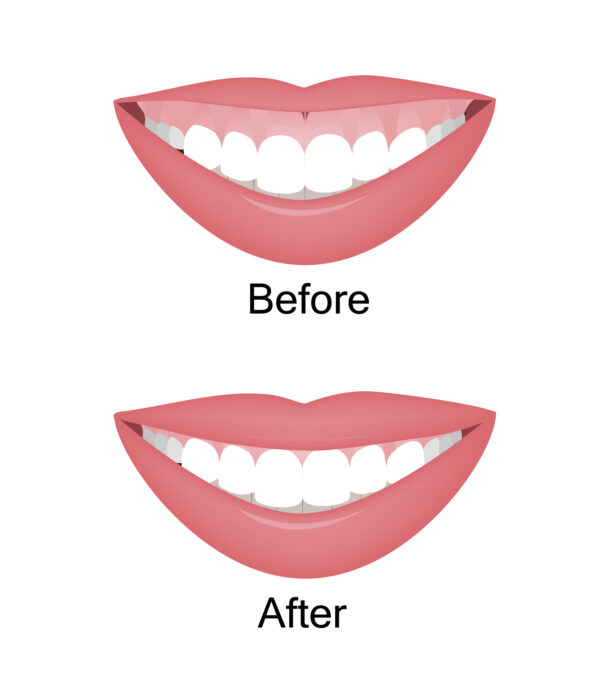 A "gummy smile," one in which there is an abnormally large amount of gum tissue, can be addressed with Botox® injections.