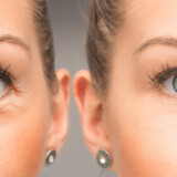 Under-Eye Botox: A Magical Way to Refresh Your Look