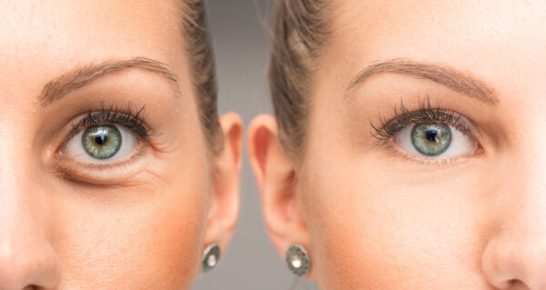 The use of Botox to treat wrinkles and fine lines around the eyes and forehead has a lengthy track record of efficacy.