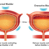 Botox as a Treatment for Overactive Bladder