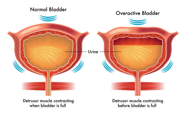 Due to its efficacy and typically well-tolerated nature, Botox has been approved by the FDA for the treatment of overactive bladder.