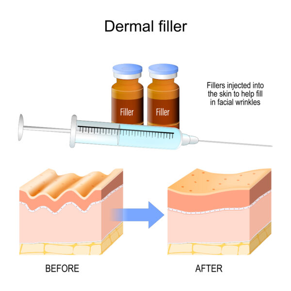 Dermal fillers are a variety of chemicals that can be carefully injected into the skin or other soft tissues to improve their appearance.
