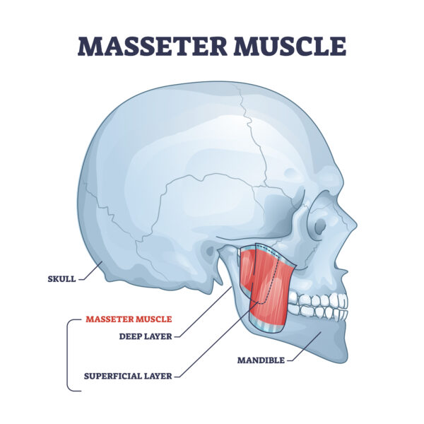   Botox injections in the masseter muscle can relax this facial muscle, reducing the jawline, known as "Jawline Slimming."