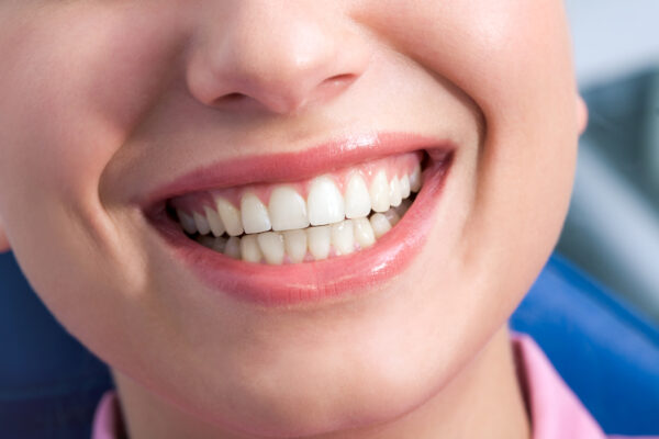 Ten percent of the population may have a more prominent gum show when they smile.