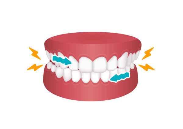 In addition to the obvious health risks, teeth-grinding can also have cosmetic effects, such as giving you a rounder face.