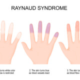 Not Only for Wrinkles: Comprehending Raynaud’s Phenomenon and Botox as a Medical Choice