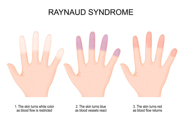 Raynaud's phenomenon is a vascular disorder that involves the periodic narrowing of blood vessels, mainly in the extremities. 