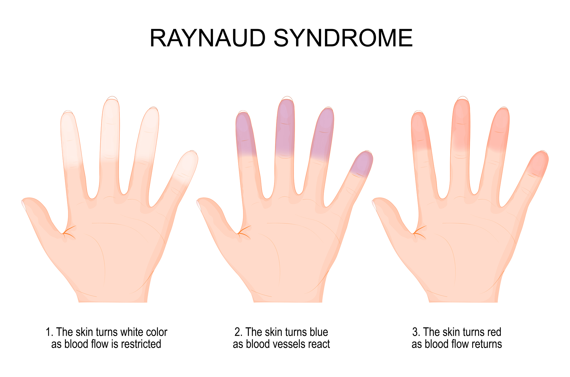 Not Only for Wrinkles: Comprehending Raynaud's Phenomenon and
