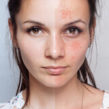 Dermal Fillers and Their Transformative Role in Minimizing Acne Scars