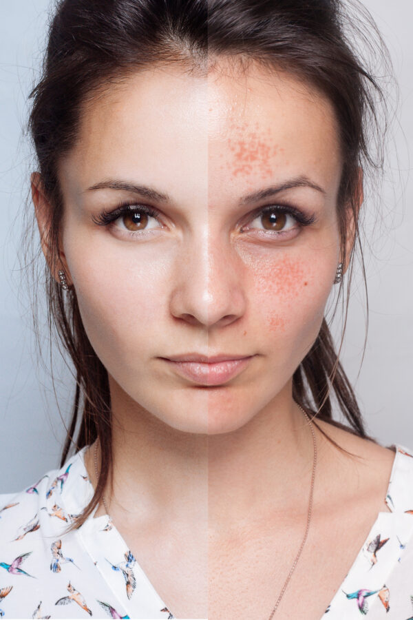 For those who suffer from acne scars, dermal fillers have just emerged as a potentially life-changing treatment option. 