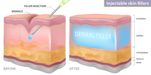Due to its many benefits, dermal fillers are a popular cosmetic rejuvenation option.