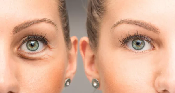 Under-Eye Botox: A Magical Way to Refresh Your Look - Botox Training &  Education